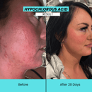 Kanzen Skincare | Derma Anti-Bacterial Hypochlorous Acid Cleansing Water